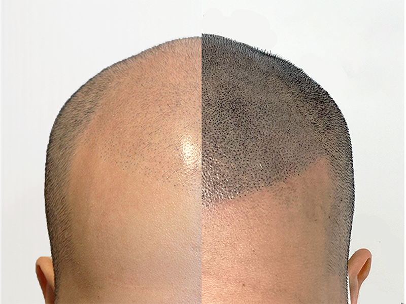 Hair loss treatment, SMP, OJO de Bella Hong Kong beauty salon