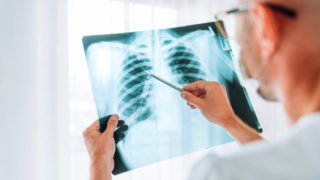 lung cancer - symptoms and treatment