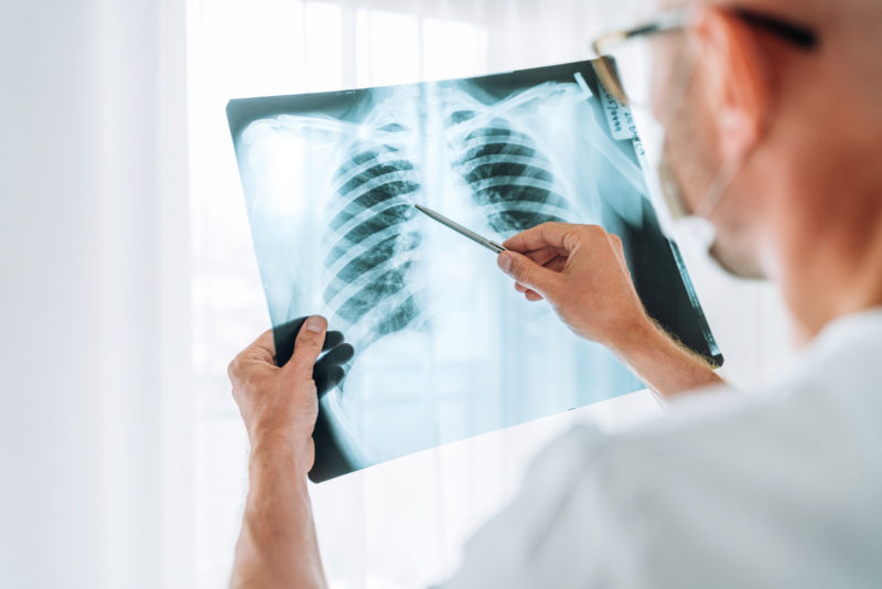 lung cancer in Hong Kong - screening, symptoms and treatment