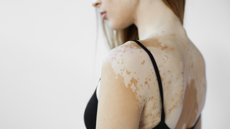 vitiligo treatment, causes of vitiligo, skin condition