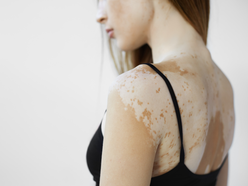 vitiligo treatment, causes of vitiligo or skin condition