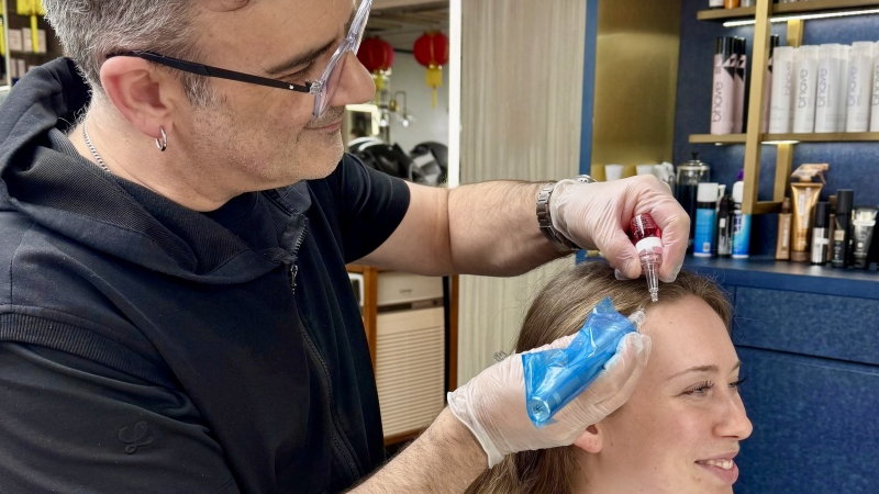 microneedling hair loss, telogen effluvium, thinning hair,