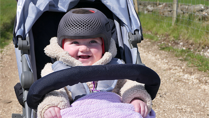 flat head syndrome in babies