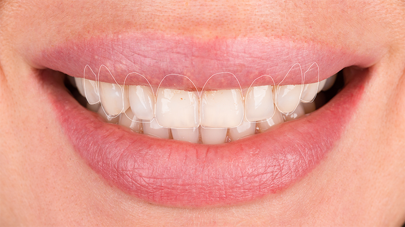 Teeth whitening, cosmetic dentistry in Hong Kong